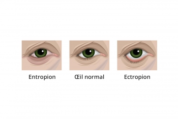 Traitements Entropion Ectropion Troubles Oculaires A Toulouse