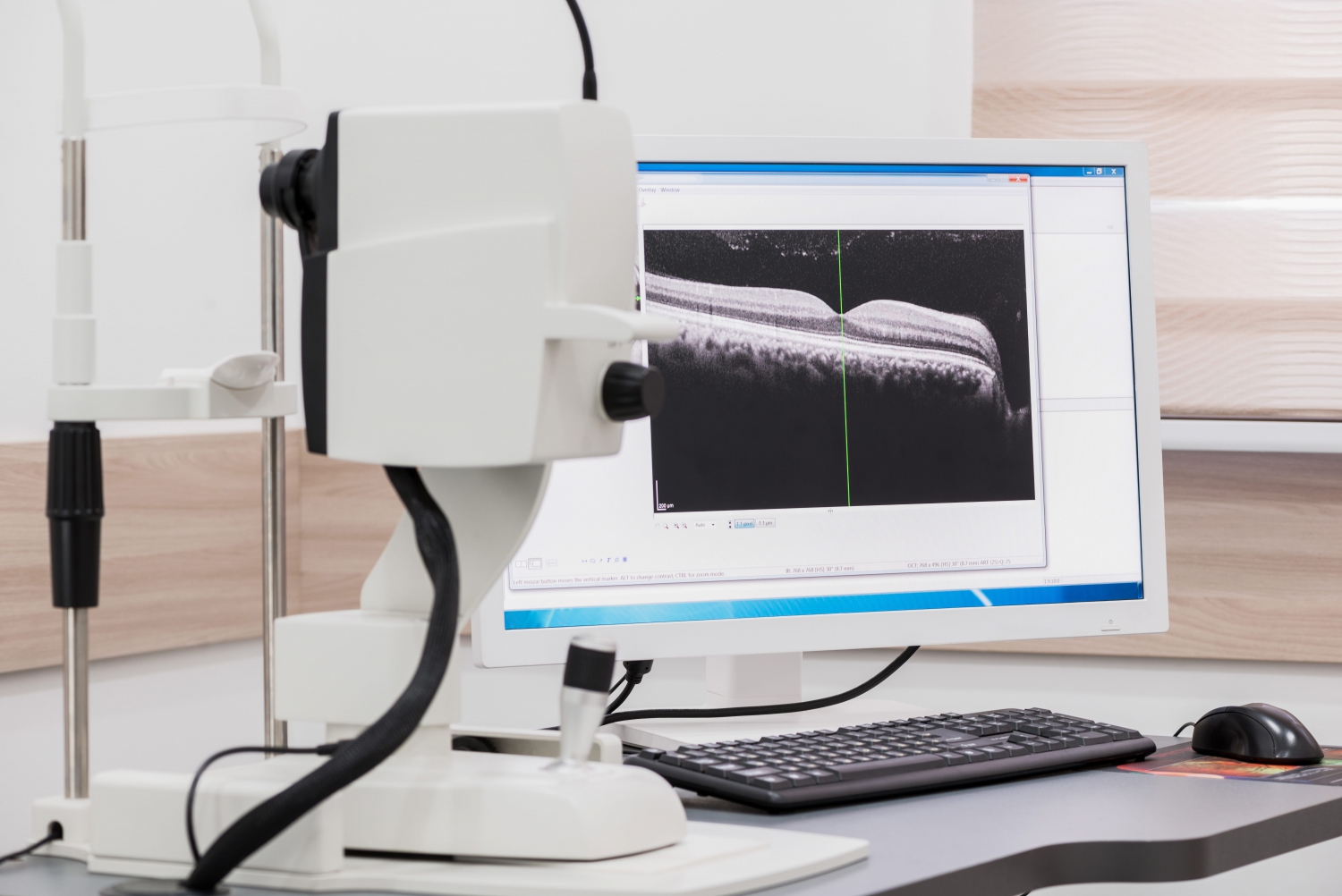 Tomographie en cohérence optique (OCT)