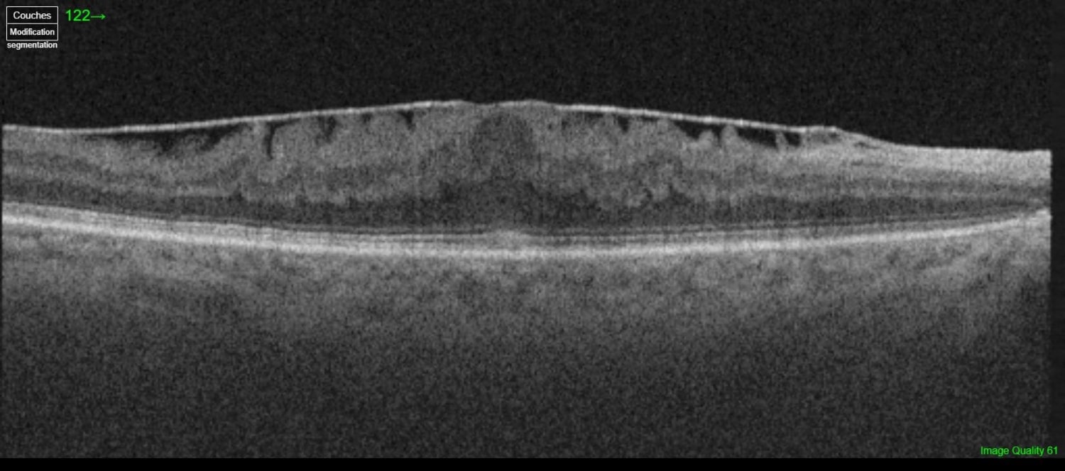 Membrane épimaculaire