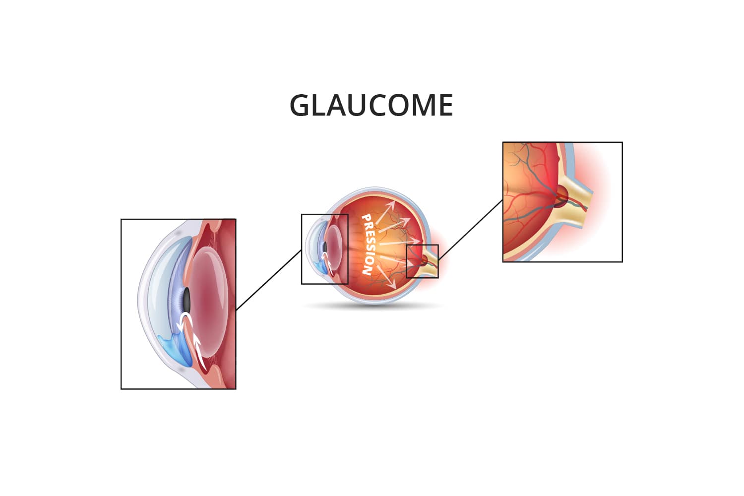 Traitement glaucome chronique à angle ouvert à Toulouse