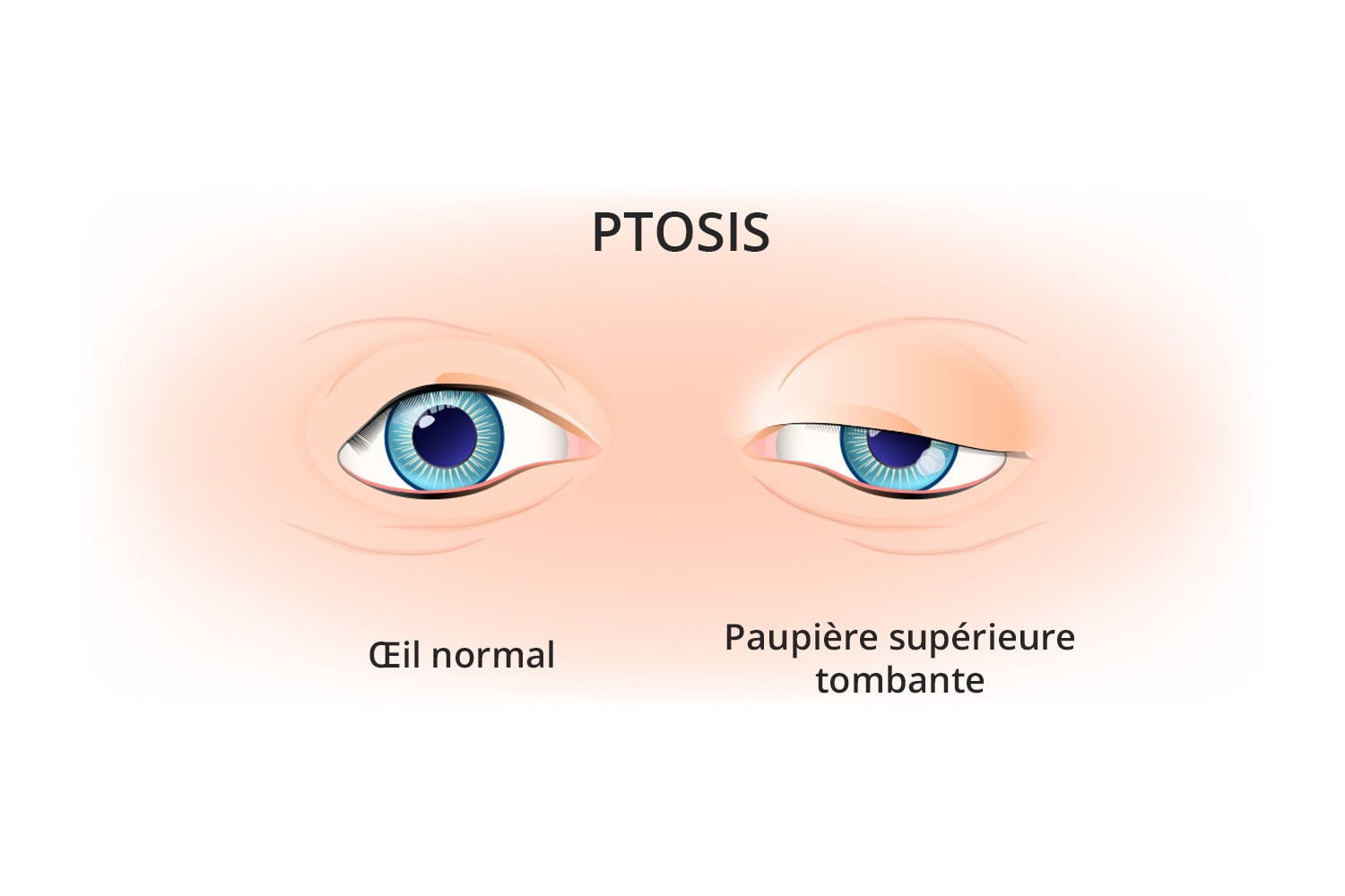 Chirurgie du ptosis à Toulouse