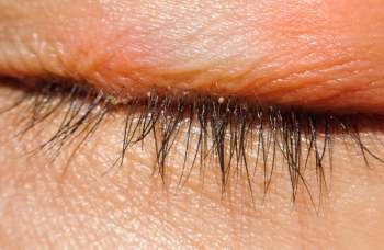Symptomes Traitements Blepharite Toulouse Inflammation Des Paupieres